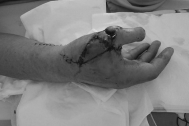 Cắt ngón chân lên thay ngón tay cái bị cưa cắt cụt