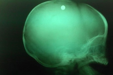 Chị gái nghịch súng, bé trai 6 tháng tuổi bị bắn vào đầu