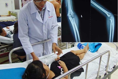 Bó thuốc Nam, coi chừng tay trẻ bị biến dạng