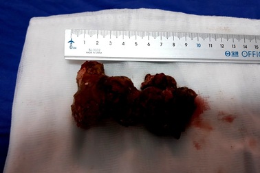 Lấy khối sỏi thận khủng trong thận bệnh nhân 60 tuổi