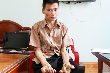 Thăm người đàn ông mang bệnh “người cây” ở Ninh Bình