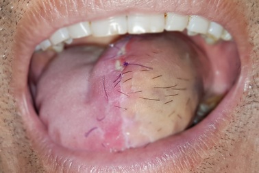 Ngày càng nhiều người trẻ mắc căn bệnh hiểm phải cắt lưỡi, đau đớn nặng nề