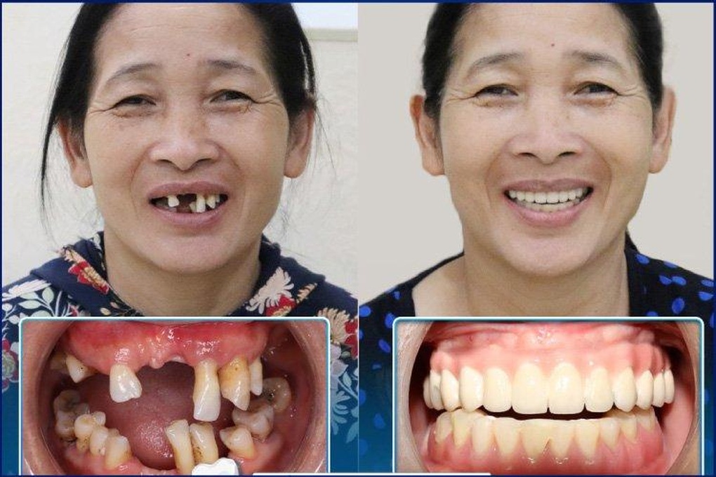 Công nghệ Safe Tech: Trồng răng an toàn và thành công cho người cao tuổi - 4 Công nghệ Safe Tech: Trồng răng an toàn và thành công cho người cao tuổi - 4