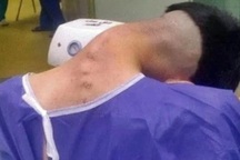 Nam thanh niên mắc "hội chứng đầu gục" do lạm dụng chất gây nghiện