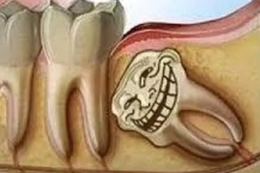 Răng khôn, vì sao phải nhổ bỏ?