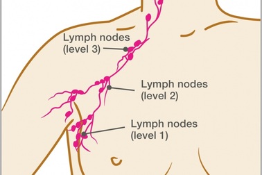 Nổi hạch ở nách khi nào cần đi khám?