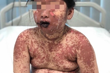 Bé gái 7 tuổi lở loét toàn thân sau khi uống thuốc mua ở phòng mạch tư