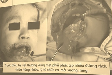 Đang ăn xúc xích, bé trai bị chó tấn công cướp đồ ăn, cắn vùng đầu mặt