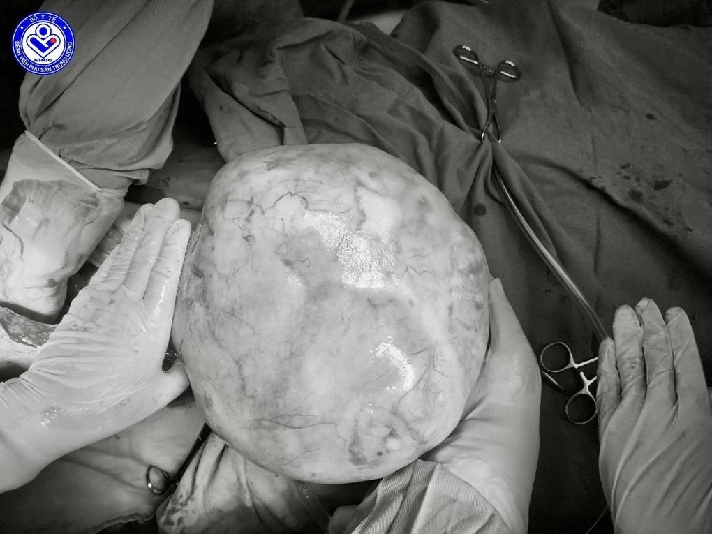 Bé gái 14 tuổi mang khối u buồng trứng hơn 4kg, gia đình tưởng tăng cân - 1