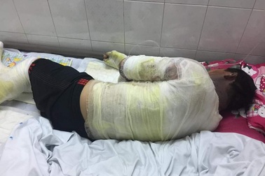 Nổ can xăng, 2 vợ chồng bỏng nặng