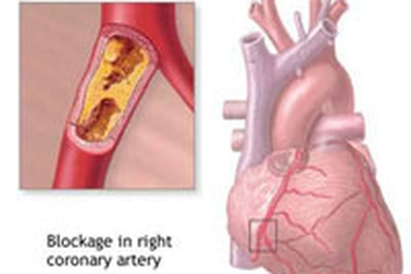 Thiếu vitamin D, nguy cơ bệnh tim tăng gấp đôi 