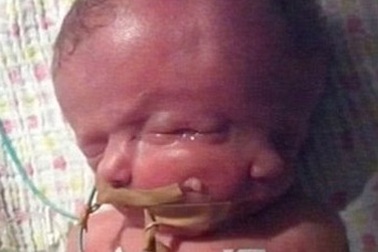 Em bé hai mặt đã qua đời