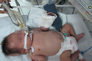 Bé trai nguy kịch, hoại tử 5 đầu ngón tay sau tiêm vắc xin lao?