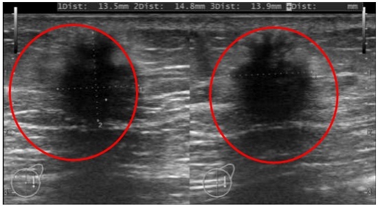 Tình cờ đi khám sức khỏe phát hiện mắc loại u hiếm gặp - 1