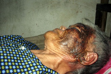 Nàng dâu hắt phích nước sôi vào mặt mẹ chồng