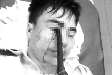 Phẫu thuật thành công trường hợp bị cán gương đâm xuyên hốc mắt