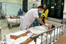 Nổ điện thoại khi sạc, bệnh nhân mù mắt, chi chít hàng trăm vết thương