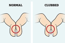 Cách kiểm tra ngón tay đơn giản để biết liệu bạn có bị ung thư phổi không
