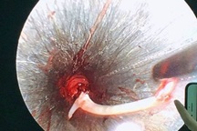 Người đàn ông suýt mất mạng vì tin lời thầy mo uống “nước thần” để chữa hóc xương cá