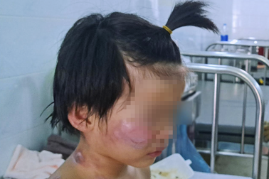 4 trẻ bị bỏng vì cháy nhà: Mẹ vừa chở cha đi làm thì hay tin con gặp nạn