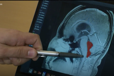 Ngất xỉu, đau đầu dữ dội vì sán sống trong não cả thập kỷ