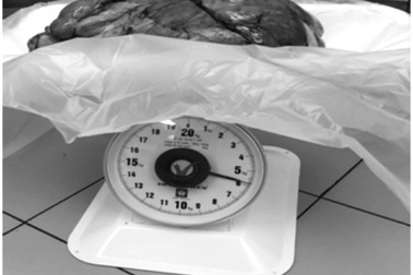 Đau tức bụng vào viện, người đàn ông phát hiện khối u nặng 6kg