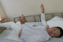 Dùng cồn nướng cá, nhân viên y tế bỏng nặng