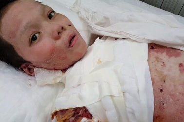 Tình hình cháu Sơn bị bỏng nặng sau khi ghép da