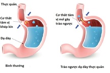 Nguy hiểm đến từ trào ngược dạ dày thực quản