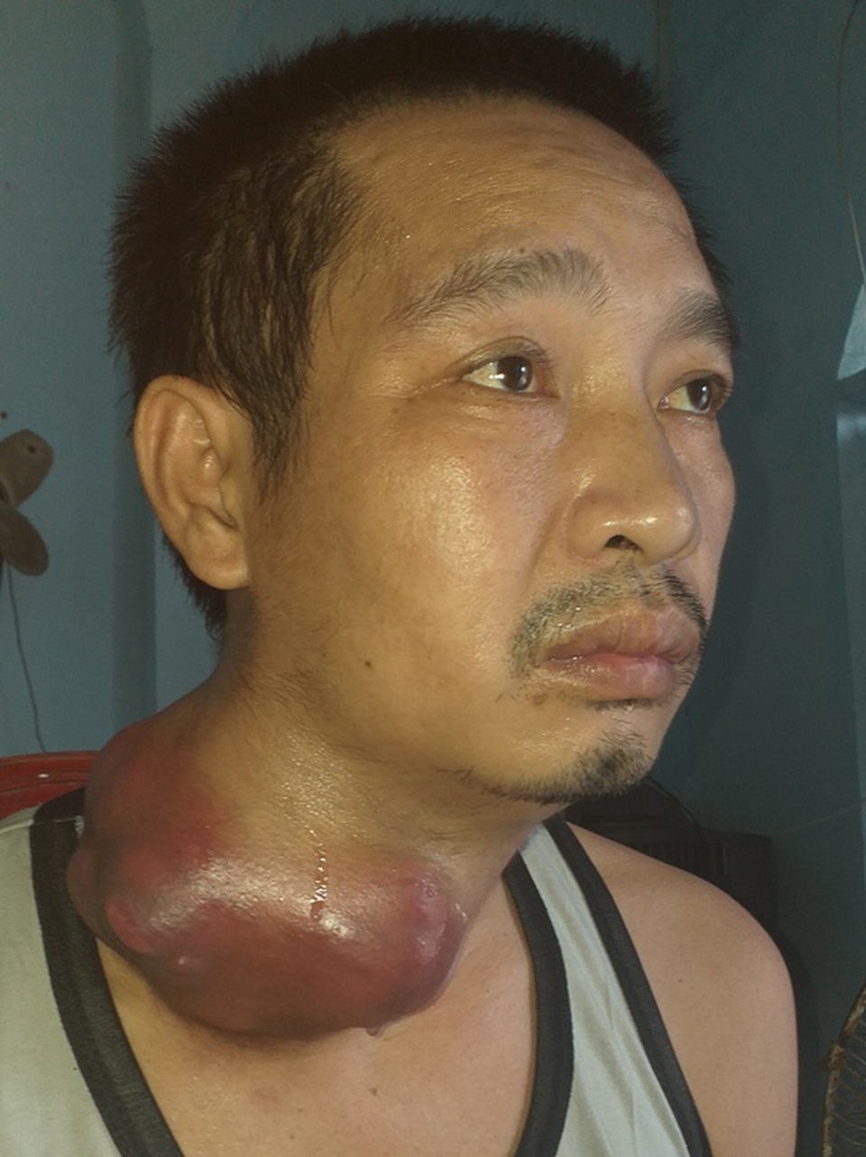 Người đàn ông nghèo đau đớn mang khối u như những chiếc bát úp vào cổ - 1 Người đàn ông nghèo đau đớn mang khối u như những chiếc bát úp vào cổ - 1
