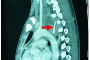Xương gà đâm thủng thực quản, cháu bé suýt tử vong