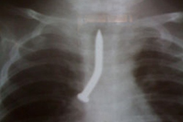 Bé 6 tháng tuổi nuốt đinh vào cuống phổi