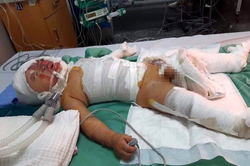 Cháu bé 2 tuổi bị bỏng xăng nặng được bạn đọc giúp đỡ gần 500 triệu đồng - 4 Cháu bé 2 tuổi bị bỏng xăng nặng được bạn đọc giúp đỡ gần 500 triệu đồng - 4