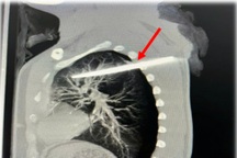 Cấp cứu nam thanh niên với vết thương thấu ngực, dị vật cắm sâu trong phổi