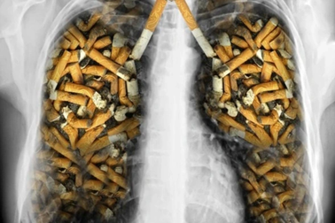 "Điểm mặt" các yếu tố làm tăng nguy cơ ung thư phổi