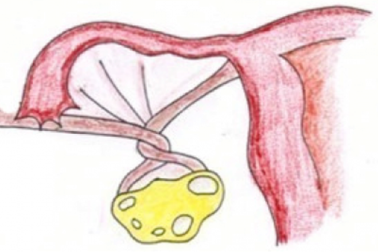 Biến chứng u nang buồng trứng có nguy hiểm không?