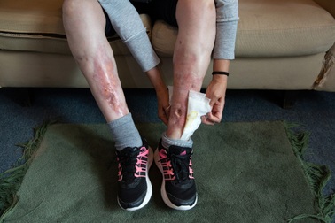 Đáng sợ hình ảnh cơ thể bị tàn phá sau trào lưu làm đẹp tức thời