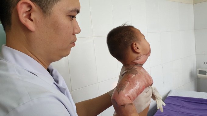 Quảng Ninh: Trẻ 2 tuổi bỏng nặng do ngã vào nồi lẩu, bác sĩ cảnh báo tuyệt đối không dùng biện pháp này để sơ cứu - Ảnh 1. Quảng Ninh: Trẻ 2 tuổi bỏng nặng do ngã vào nồi lẩu, bác sĩ cảnh báo tuyệt đối không dùng biện pháp này để sơ cứu - Ảnh 1.