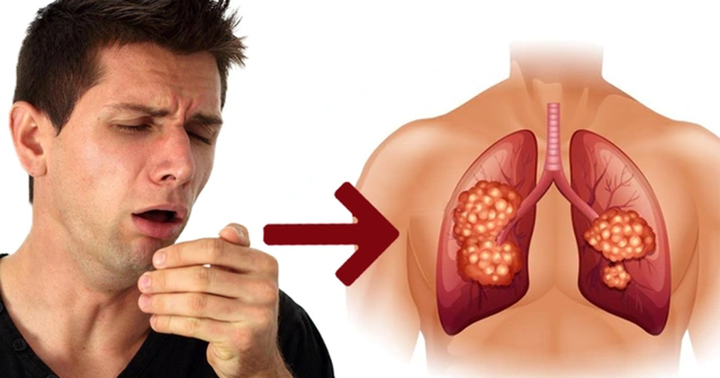 Vì sao nhóm người sau cần phải tầm soát ung thư phổi định kỳ? - 1 Vì sao nhóm người sau cần phải tầm soát ung thư phổi định kỳ? - 1