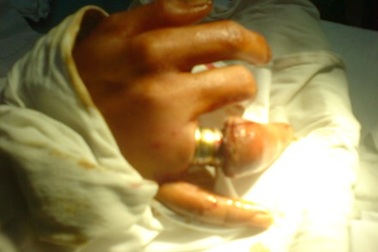 Suýt mất ngón tay, “chân giữa” vì đeo nhẫn 