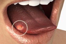 Nốt lạ trong miệng cảnh báo dấu hiệu ung thư lưỡi