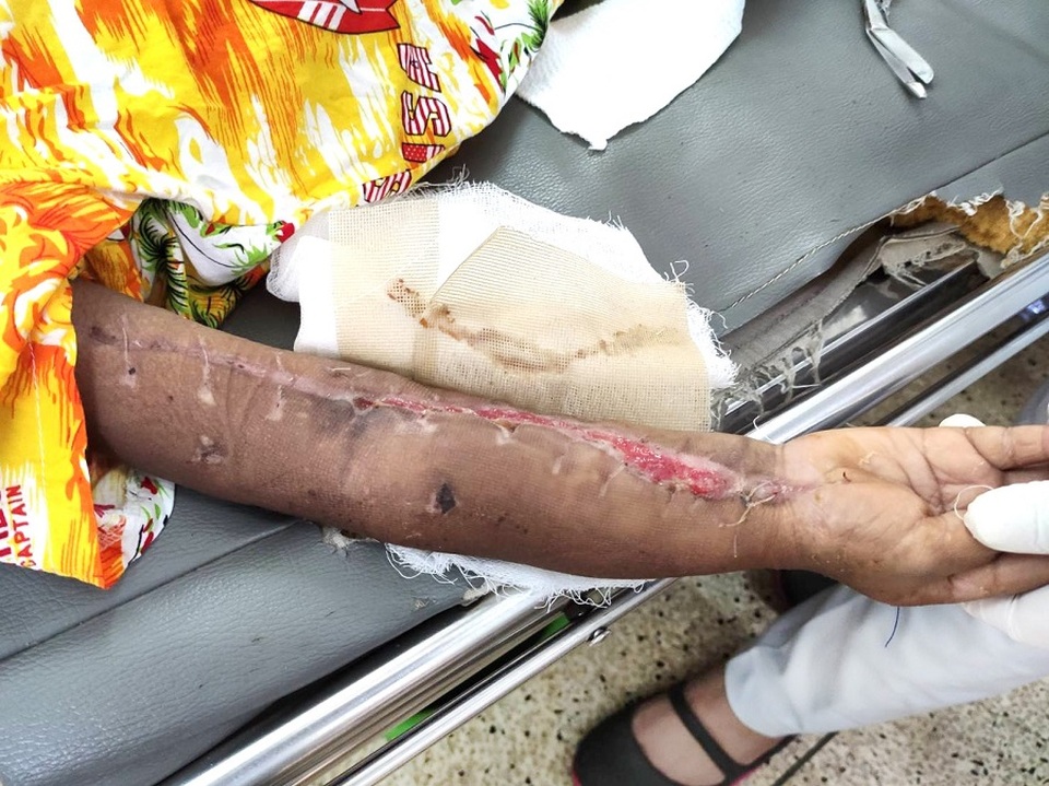 Bé 4 tuổi suýt mất mạng vì người nhà đắp lá thuốc chữa chấn thương - 2