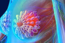 Tìm hiểu về liệu pháp nội tiết tố mới trong điều trị ung thư vú