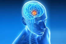 Dấu hiệu nhận biết u não lành tính