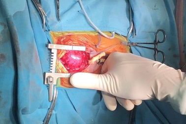 Trái tim lớn hơn ngón tay cái hồi sinh sau 2 lần phẫu thuật