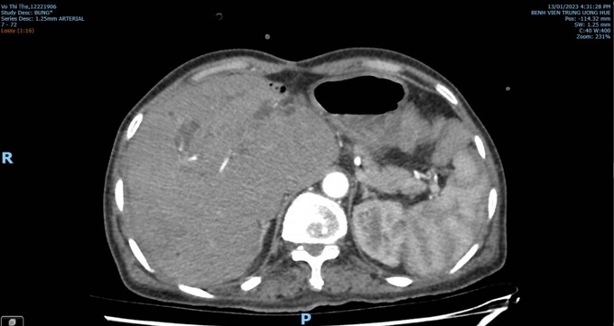 Ảnh chụp CT Scan vùng bụng cho thấy bệnh nhân bị vỡ giả phình động mạch gan do áp xe gan