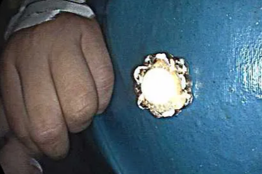 Bông hoa bằng sắt chui tọt vào thực quản bé trai 4 tuổi