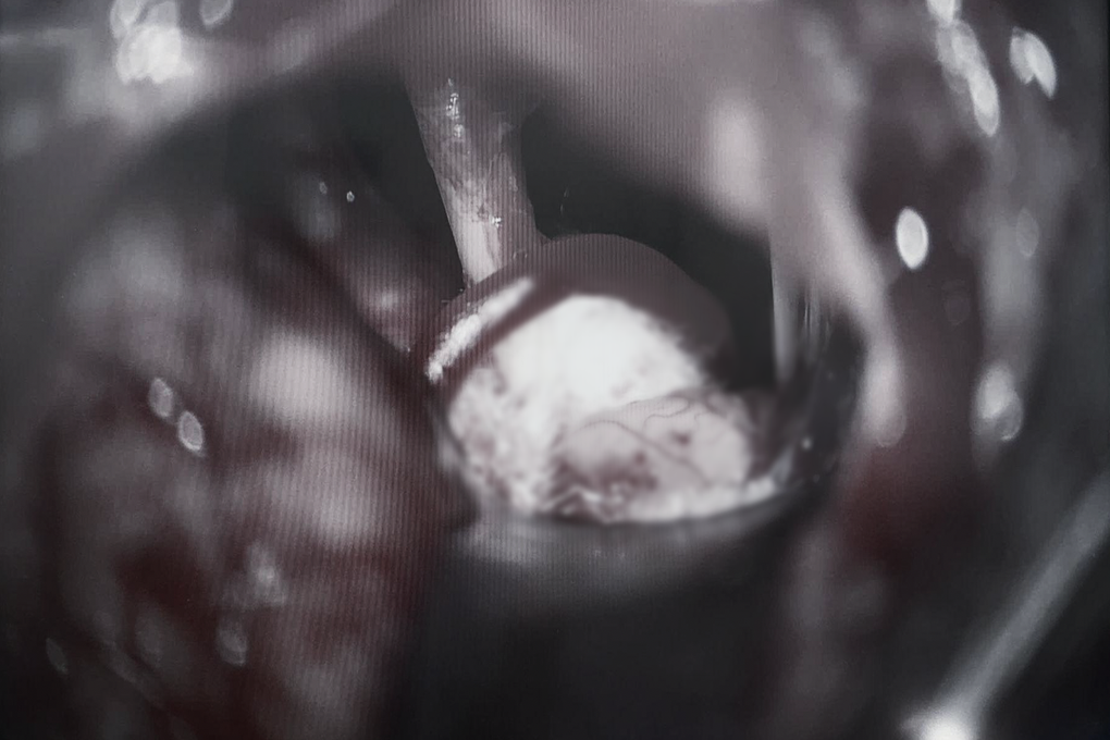 Mulher sofre de doença perigosa há 1 ano, mas achou que era um “bom presságio” - 2 Người phụ nữ mắc căn bệnh nguy hiểm suốt 1 năm nhưng lại tưởng “điềm lành” - 2