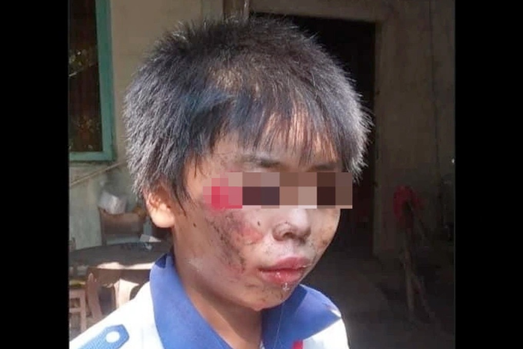 Nam sinh lớp 6 bị bạn học xô ngã xuống mương làm mặt bê bết máu - 1 Nam sinh lớp 6 bị bạn học xô ngã xuống mương làm mặt bê bết máu - 1