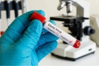 Bộ Y tế chỉ đạo khẩn ứng phó với bệnh do virus Ebola